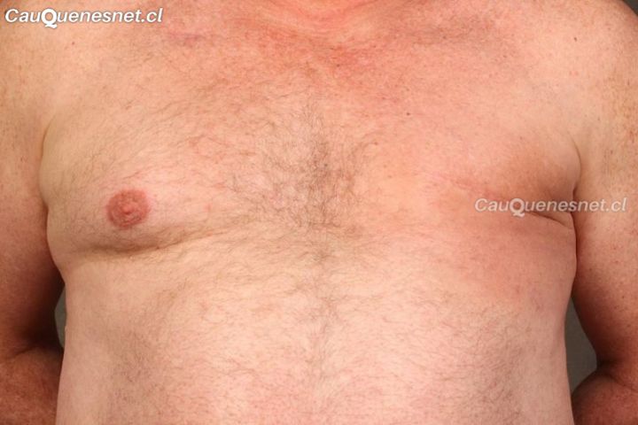 Cáncer de mama en hombres: Una enfermedad neoplásica poco frecuente